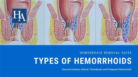 Thrombosed Hemorrhoid One Month at Henry Flaherty blog