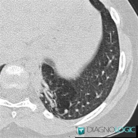 Radiology case : Pulmonary sequestration (CT) - Diagnologic