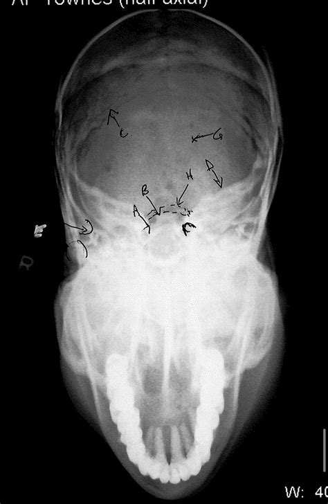 AP Townes Radiograph Diagram Quizlet