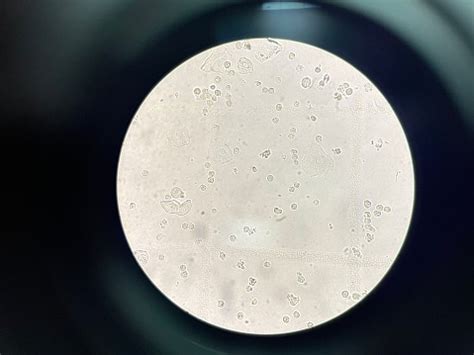 White Blood Cell In Urine Stock Photo - Download Image Now - AIDS ...