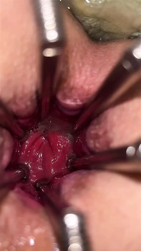 Spéculum gynécologique anal xHamster