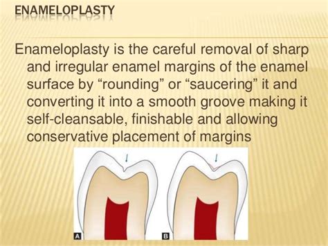 Steps Of Cavity Preparation