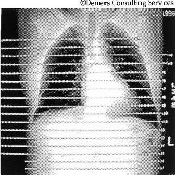 A posteroanterior chest radiograph taken in preparation for a CT scan ...