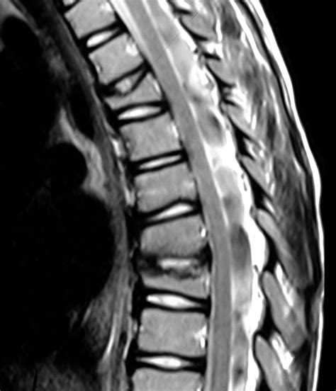 Imaging Of Chronic Recurrent Multifocal Osteomyelitis Radiographics