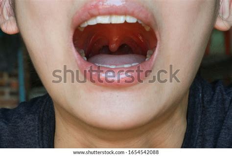 Uvula Cancer Symptoms