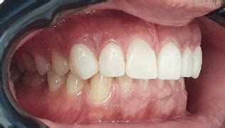 Gap Between Teeth Fixed Composite Veneer Before After Photos