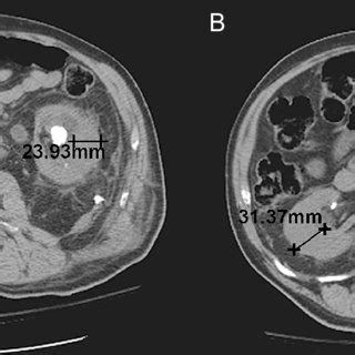 (PDF) Renal parenchyma thickness: A rapid estimation of renal function ...