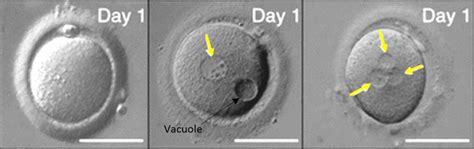 Choosing Embryos For Transfer Or Freezing Fertility Solutions Is Now