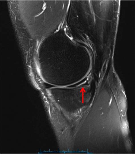 Meniscus Tear Mri | www.pixshark.com - Images Galleries With A Bite!