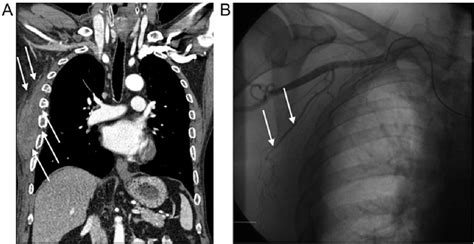 Figure 1 from Spontaneous intermuscular hematoma in a patient receiving ticagrelor and aspirin ...