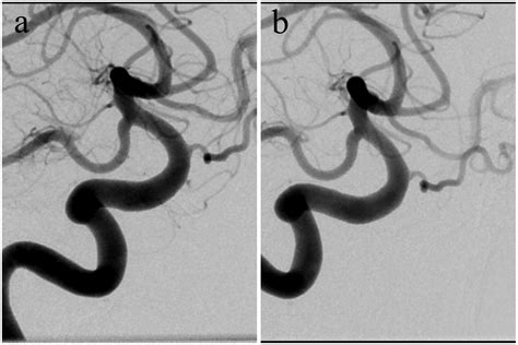 Pipeline Embolization For An Iatrogenic Intracranial Internal Carotid