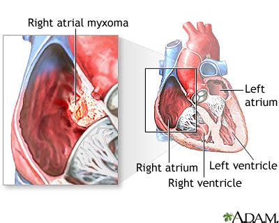 Atrial myxoma | UF Health, University of Florida Health