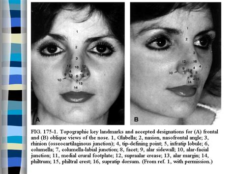 Rhinoplasty Approaches Anatomy Techniques