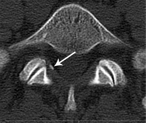 The Relationship Between The Prevalance And Size Of Lumbar Ossified Ligamentum Flavum And The