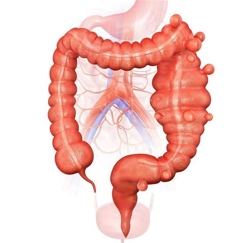 Diverticulitis El Trastorno Que Afecta El Tracto Digestivo Y Cómo