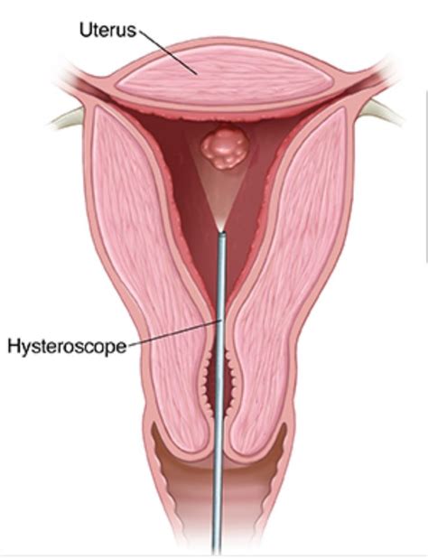 Hysteroscopy | Fibroids, Health