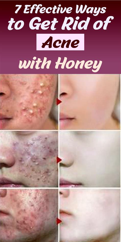 7 Effective Ways To Get Rid Of Acne With Honey How To Get Rid Of Acne