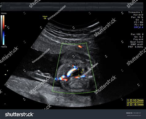 Baby On Ultrasound Image Stock Photo 145180141 | Shutterstock