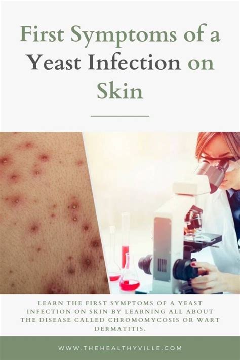 First Symptoms of a Yeast Infection on Skin | Yeast infection on skin ...