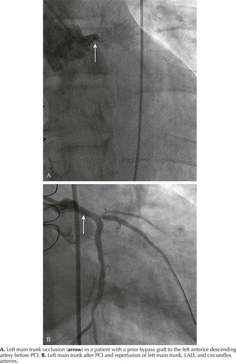 6 Acquired Heart Disease Thoracic Key