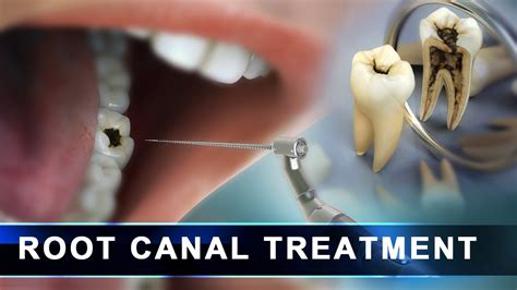 Root Canal Treatment step by step | Curveia Dental Animation in 3D - Endodontics for tooth decay ...