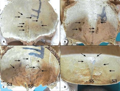 Hypertrophic changes in the form of osseous thickening plaques. A ...