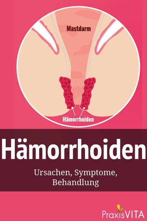 H Morrhoiden Was Sind H Morrhoiden H Morrhoiden Hausmittel Und