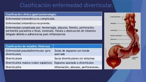 Enfermedad Diverticular Colonica