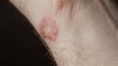 A Ringworm-Causing Superfungus Is Infecting People in New York City