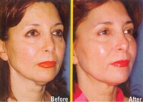 thread facelift procedure myths  facts adorable clinic