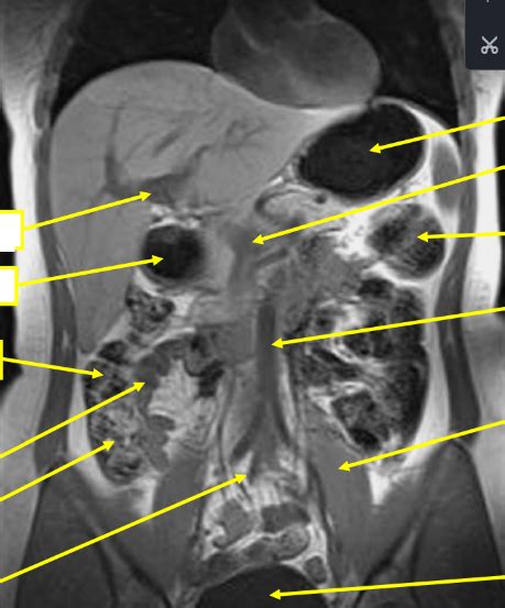 Schnittbildanatomie Abdomen COR Diagram Quizlet