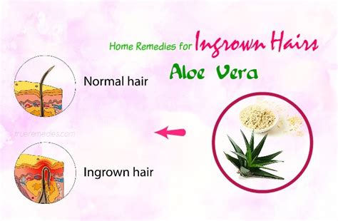 16 Effective Home Remedies For Ingrown Hairs Cyst