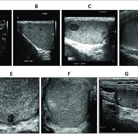 Evolution Of Testicular Ultrasonography Left A And Right B