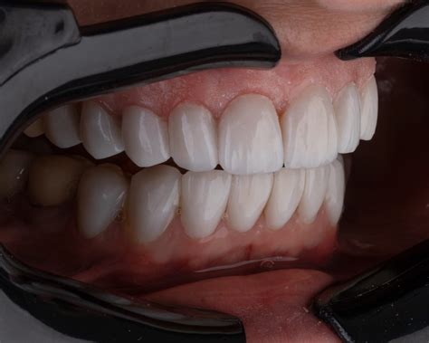 How Long Do Composite Fillings Last Vernon Dentist