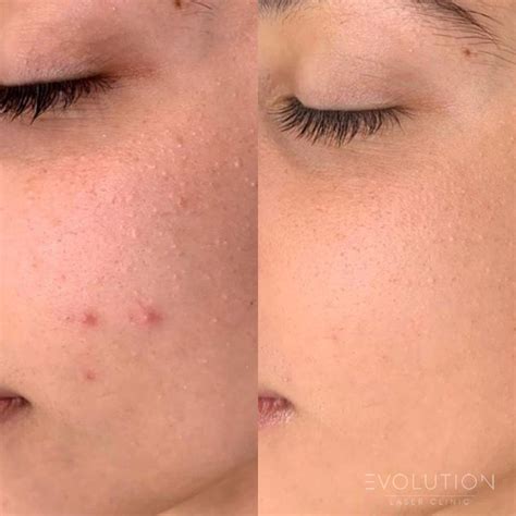 Acne Scar Reduction Sydney Best Scar Removal Treatments Elc