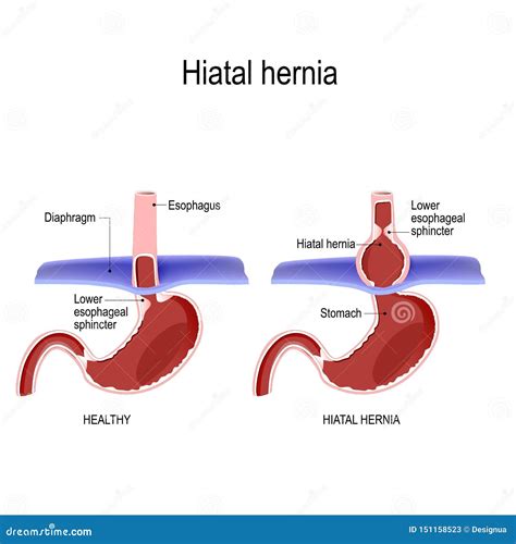 Hiatal Hernia Vector Diagram Of Normal Anatomy And Sliding Hiatal