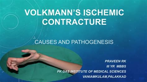 Volkmann Contracture Ppt