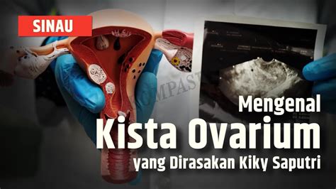 Apa Itu Kista Ovarium Yang Dialami Kiky Saputri Begini Penjelasannya