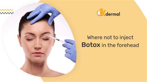 Where Not To Inject Botox Forehead Dkdermal