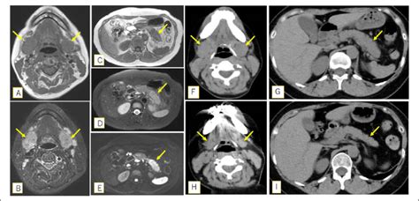 Magnetic Resonance Imaging Mri Shows Diffuse Swelling Of The