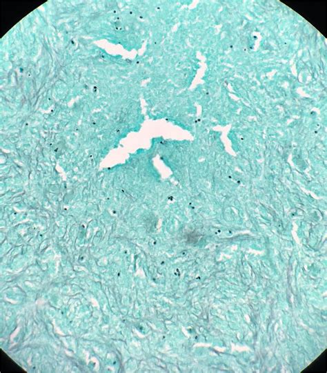 Biopsy Results Seen With Grocott Gomori Methenamine Silver Stain Gms Download Scientific