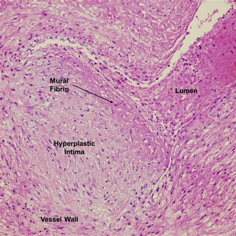 Fibrin Histology