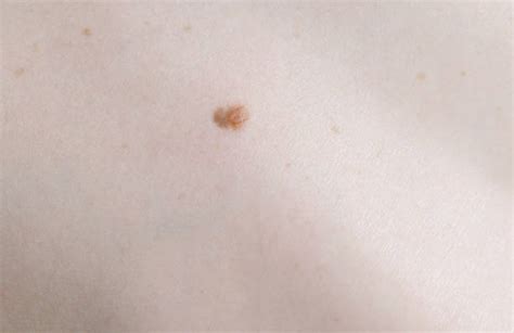 Best Mole Melanoma Skin Condition Warty Stock Photos, Pictures ...