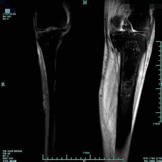 Bilateral knee joint MRI examinations show joint effusion in the left ...