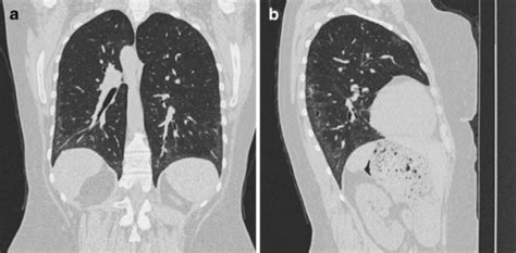 Coronal And Sagittal Chest CT Reconstructions Lung Win Open I