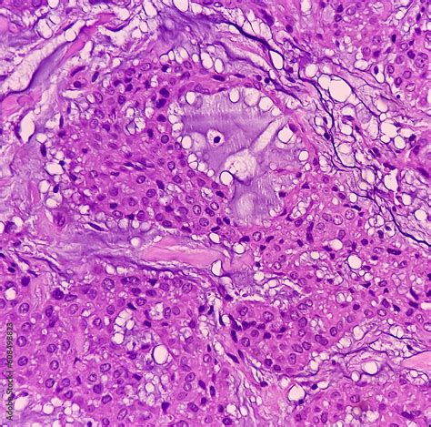 Soft Tissue Biopsy Glomus Tumor Or Paragangliomas Microscopically