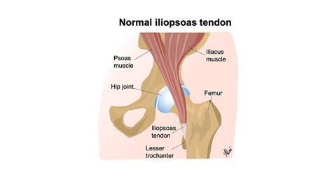 Iliopsoas Tendon Sheath Cortisone Injection Musculoskeletal