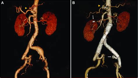 Three Dimensional Reconstruction Of The Computed Tomographic Angiogram