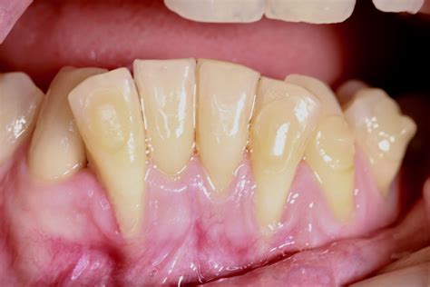 La enfermedad de las encías piorrea se llama Enfermedad periodontal