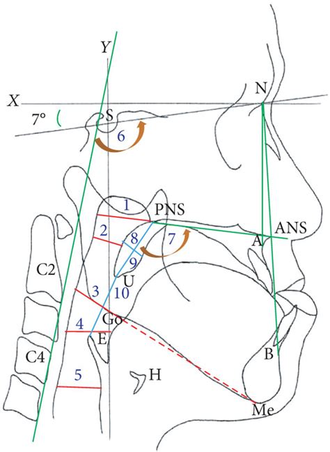 Cephalometric Landmarks And Linear Measurements Landmarks Nasion N